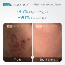 CỨ TƯỞNG MÌNH ĐANG TRỊ MỤN ĐÚNG CÁCH NHƯNG HẾT 90% CHỊ EM ĐỀU MẮC PHẢI LẦM TƯỞNG NÀY