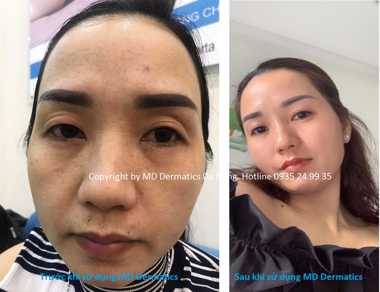 MD DERMATICS CHI NHÁNH TẠI ĐÀ NẴNG ✦ Địa chỉ:32 Pastuer, Hải Châu, TP Đà Nẵng ✦ Hotline: 0935 24 99 35 - 0935 350 419 Fanpage: https://www.facebook.com/MDdermaticsDanang/